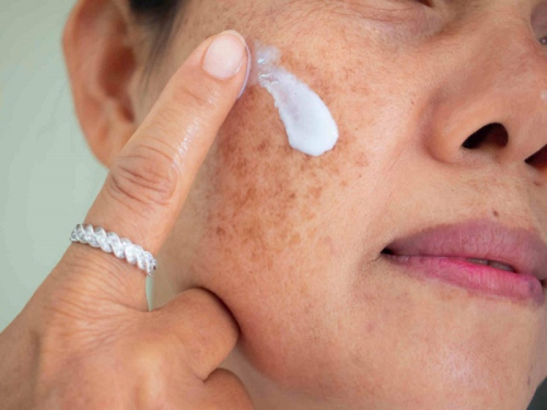 Kem trị nám da có tác hại gì hay không