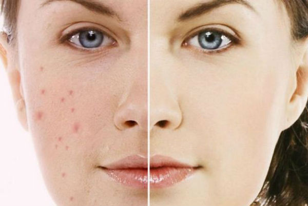 mặt nạ tẩy tế bào chết trị mụn